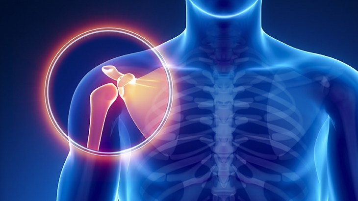 Omuz Sıkışması (İnpıngement Sendorumu) Nedir? Belirti ve Tedavisi Nasıl Olur?
