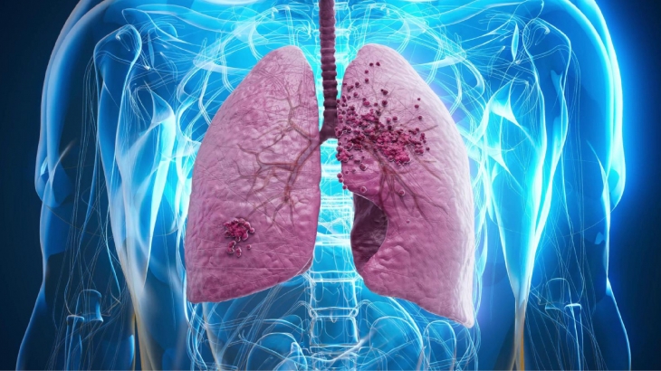 Akciğer Kanserinde Erken Teşhisin Önemi