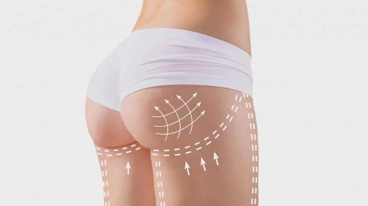 Kalçaya Yağ Transferi (Brazilian Butt Lift)